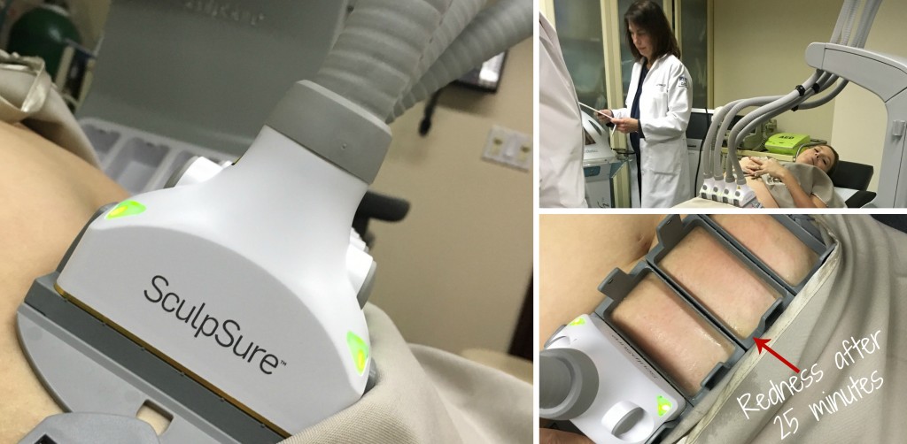 SculpSure Blogger Review